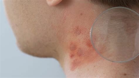 Dermatologist Examining Neck Rashes With Magnifying Glass Allergy