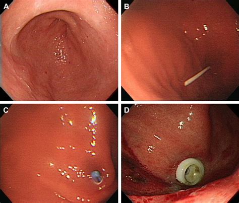 The Procedure Of Percutaneous Endoscopic Gastrostomy A A Full