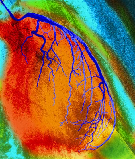 Coloured Angiogram Of Coronary Artery Of The Heart Photograph By Fine