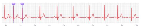 What Premature Atrial Contraction Pac Looks Like On Your Watch Ecg Qaly