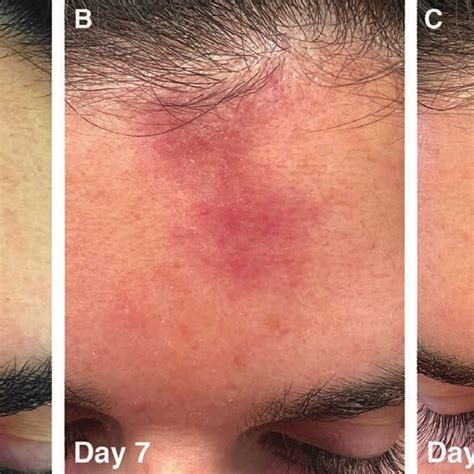 Appearance Of The Patients Forehead At Different Time Points After
