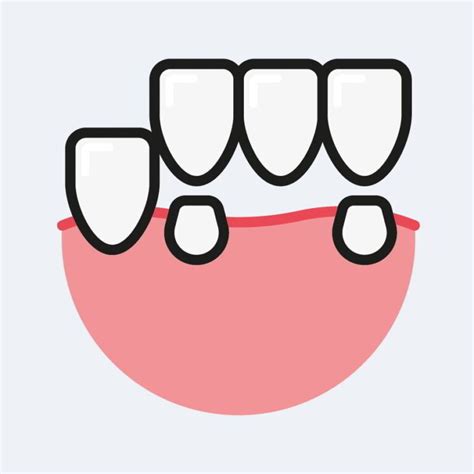 dental bridge synergy dental clinic