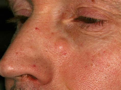 Epidermoid Cyst Symptoms Causes And Treatment