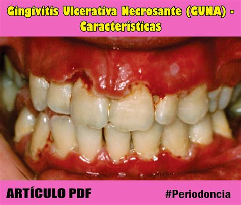 Periodoncia Gingivitis Ulcerativa Necrosante Guna Características