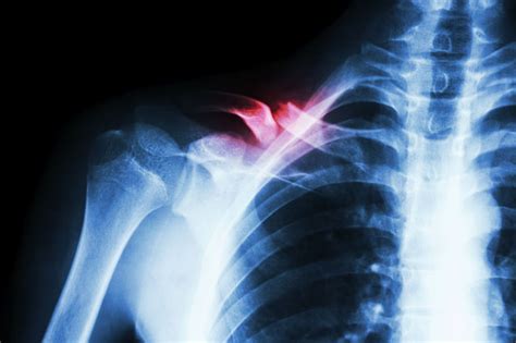 Q And A What To Expect After Breaking A Collarbone The Physical