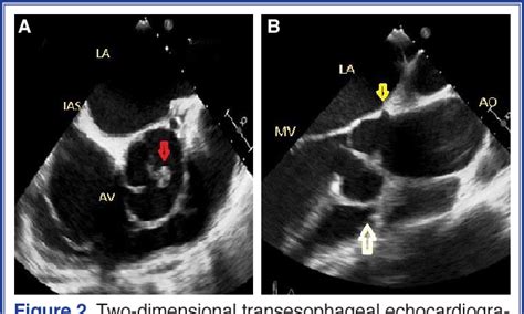Figure 4 From Infective Endocarditis Of A Bicuspid Aortic Valve