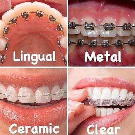 5 Types Of Braces For Teeth Metal Ceramic Self Ligating Lingual