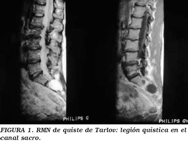 Quiste De Tarlov Y Disfunci N Vesical Sintom Tica