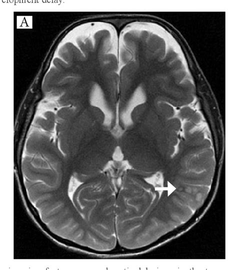 Figure 1 From Multinodular And Vacuolating Neuronal Tumor Of The