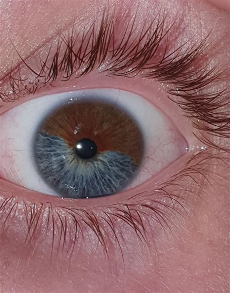 My Eye Has 2 Different Colors Mildly Interesting