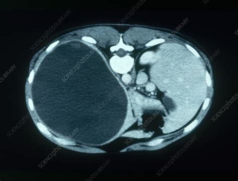 Splenic Cyst Ct Scan Stock Image C0034474 Science Photo Library