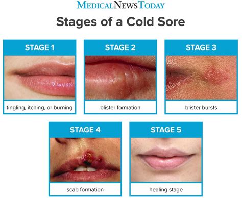 How Long Do Cold Sores Last Stages Pictures And Treatments