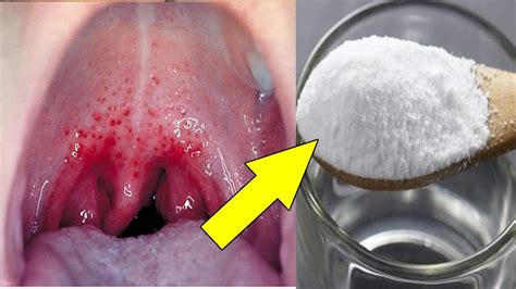 It can cause pain when swallowing or talking. How To Get Rid of Sore Throat fast| 9 Natural Remedies for ...