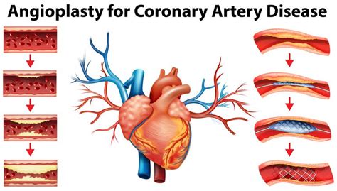 Diagram Showing Angioplasty For Coronary Artery Disease