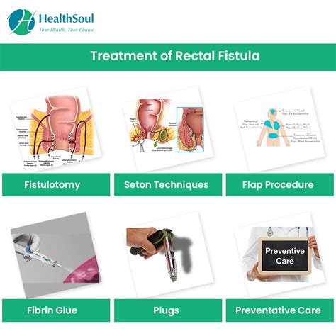 Rectal Fistula Symptoms Diagnosis And Treatment Healthsoul