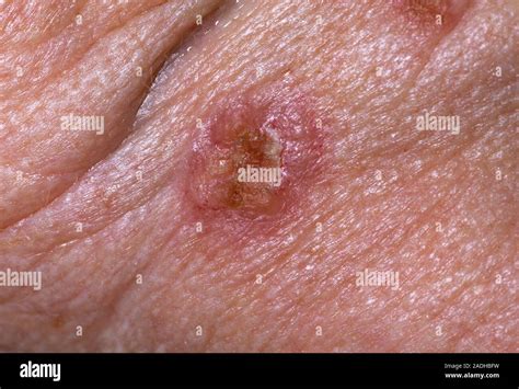 Skin Cancer Basal Cell Carcinoma Bcc Or Rodent Ulcer On The Chin