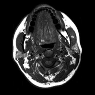 Coronal T1 MRI In A 48 Year Old Woman With A 2 Year History Of A Slowly