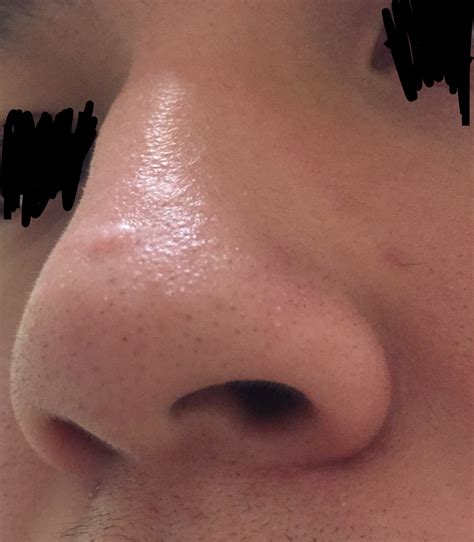 Raised Scar On Nose How Can I Get Rid Of Itw Pics Scar