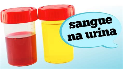 Sangramento Na Urina Descubra As Principais Causas De Hemat Ria
