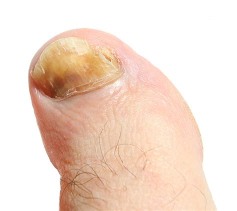 Nail Fungal Infection Causes Treatment And Symptoms