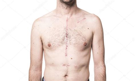 Some Scar From Open Heart Surgery In Studio Stock Photo Lopolo