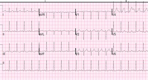 Dr Smiths Ecg Blog Low Voltage In Precordial Leads