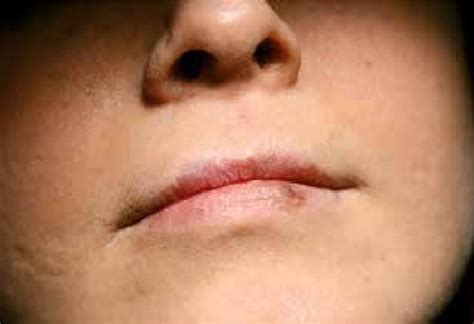 Skin Discoloration Near Lips