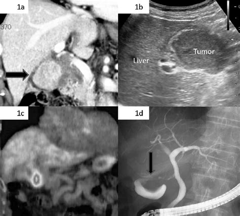 A Contrast Enhanced Abdominal Computed Tomography Shows A 50 Mm