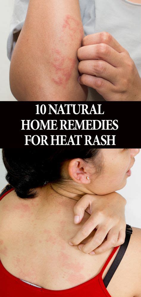 Heat Rash Symptoms And How To Treat It The New York Times Riset