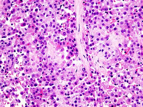 Check spelling or type a new query. Pathology Outlines - Peritoneal malignant mesothelioma