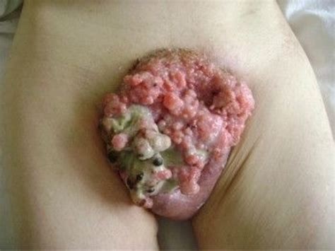 Basal Skin Cancer Squamous Cell Carcinoma Hot Sex Picture