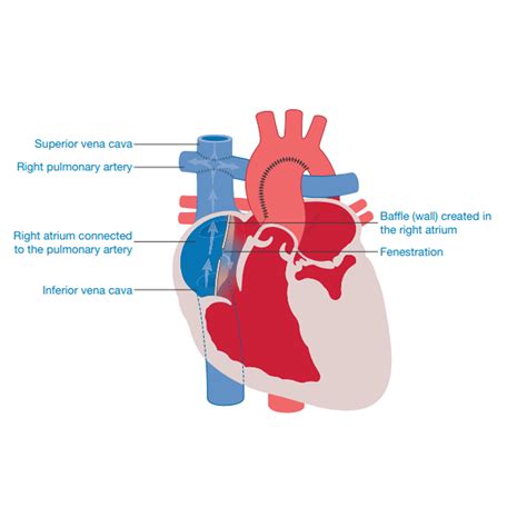 Hypoplastic Left Heart Syndrome Little Hearts Matter