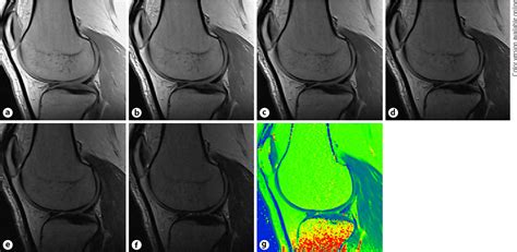 Figure 1 From Mri T2 Mapping Of Knee Articular Cartilage Using