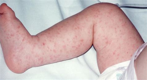 Listeria Rash Pictures Listeriosis A Rash Is Defined As A