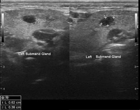 Heterogeneous Submandibular Gland Ultrasound