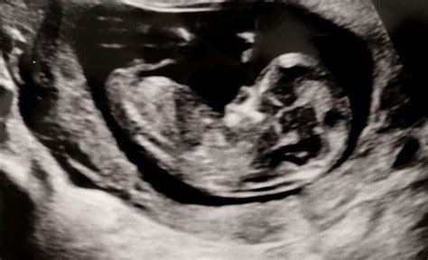 12 Week Nt Ultrasound Babycenter