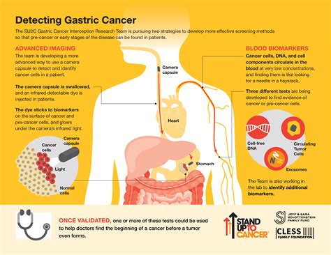 Gastric Cancer Interception Research Team Stand Up To Cancer