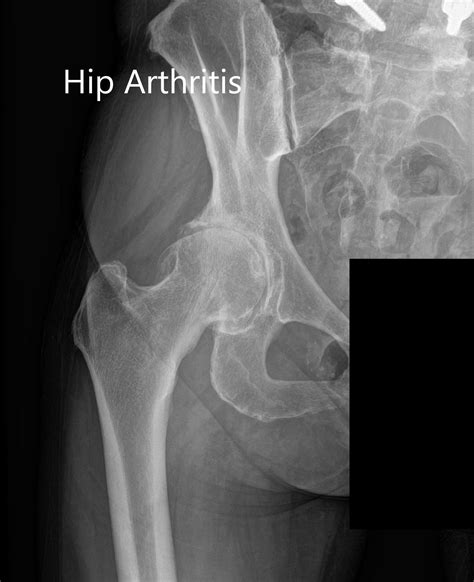 Case Study Right Hip Arthritis With Robotic Replacement