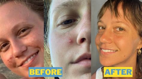 How I Cleared My Acne My Acne To Clear Skin Journey Youtube