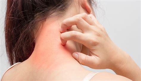 Eczema Remedies For Winter Skin Puristry