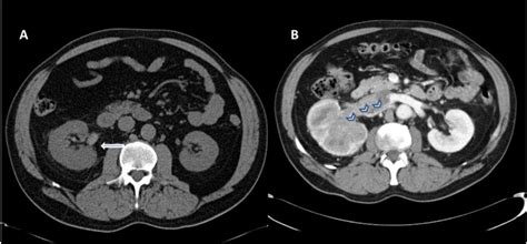 A Non Contrast Ct Scan Of Abdomen And Pelvis Demonstrates Slightly