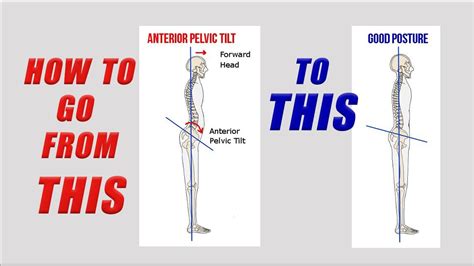 Correct Your Anterior Pelvic Tilt 5 Best Stretches And Strengthening