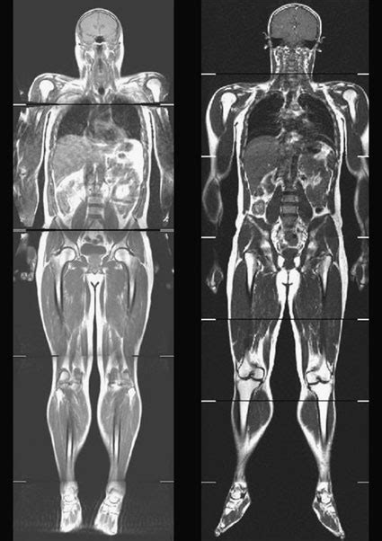 Whole Body Coronal Images Demonstrating The Tofi Thin Outside