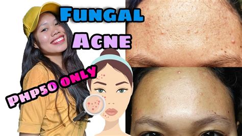 How To Get Rid Of Tiny Bumps On Forehead Fast Fungal Acne Treatment Nizoral Shampoo Youtube