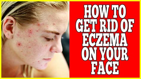 How To Get Rid Of Eczema On Face Easy And Effective Ways To Get Rid