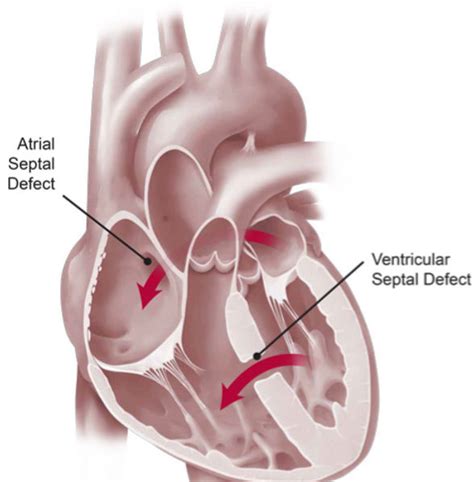 Patent Foramen Ovale Closure South Island Heart