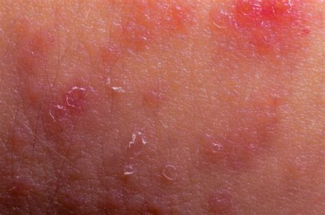 Two Gene Test Differentiates Psoriasis From Eczema Medical News Today