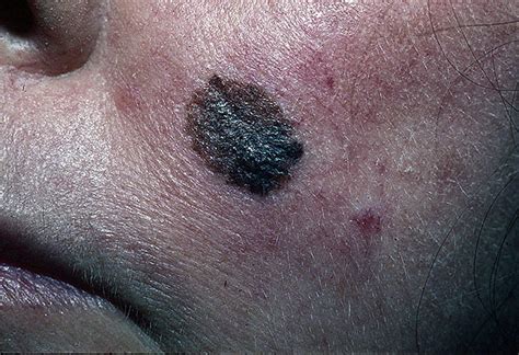 Melanoma On Face Pictures 22 Photos And Images