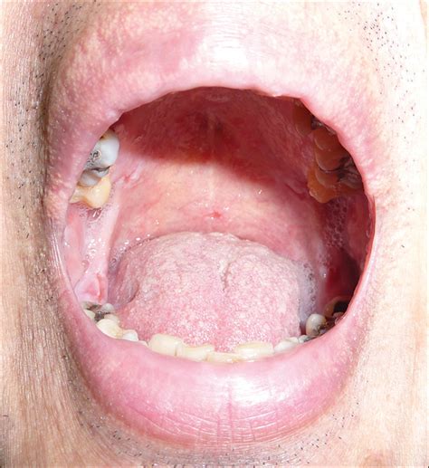 Ulcer Female Genital Sores