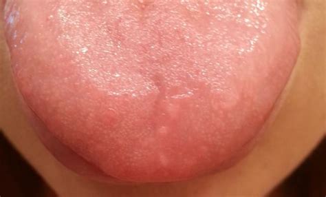 Kosmetik ohne parabene mit aktivstoffen aus der weinrebe und gründer der vinotherapie. Inflamed Taste Bud - Pictures, Causes, Treatment, Healing time